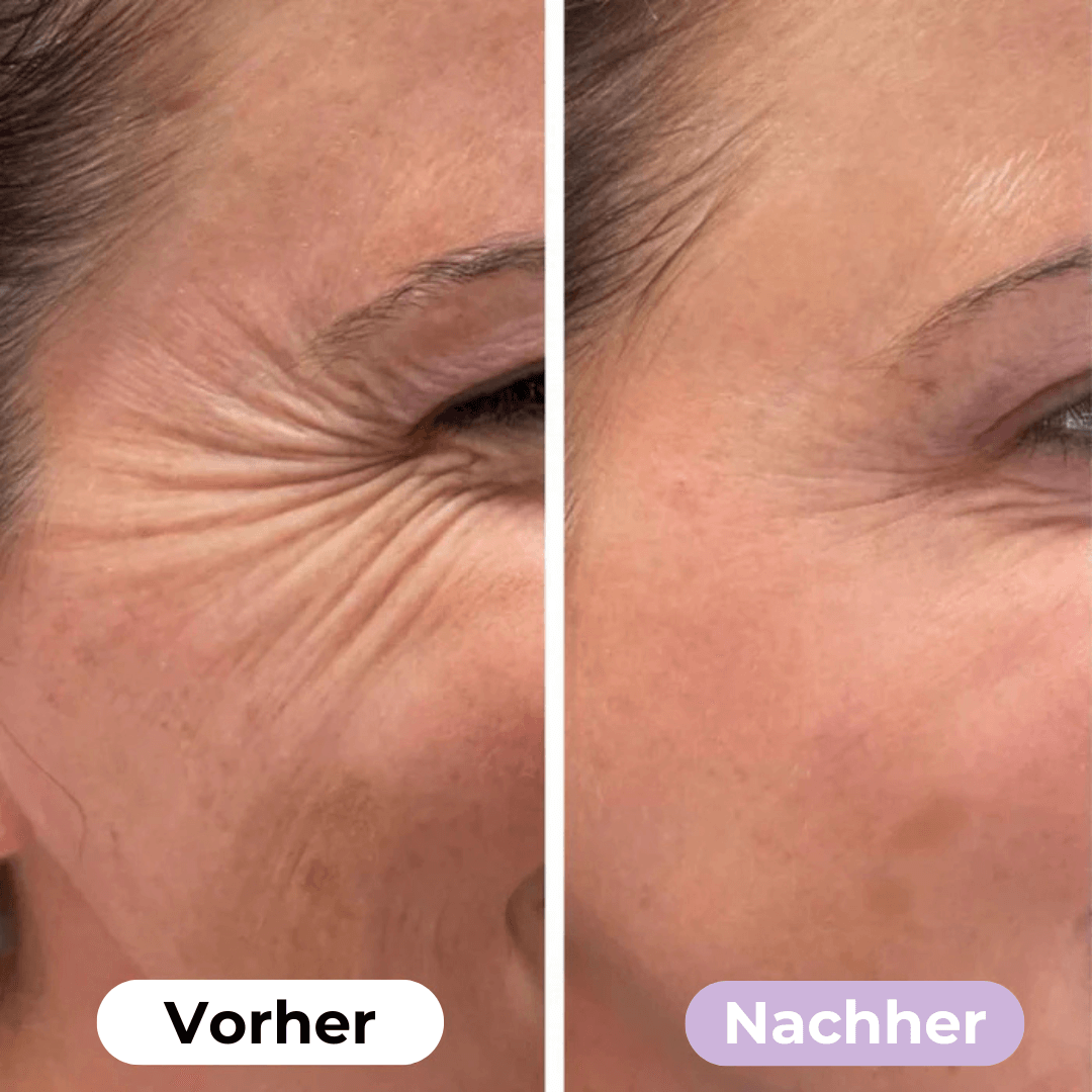 SmoothSkin™ Silicone rimpelpleisters