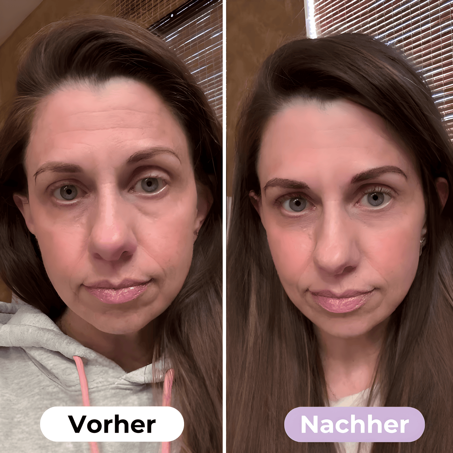 SmoothSkin™ Silicone rimpelpleisters