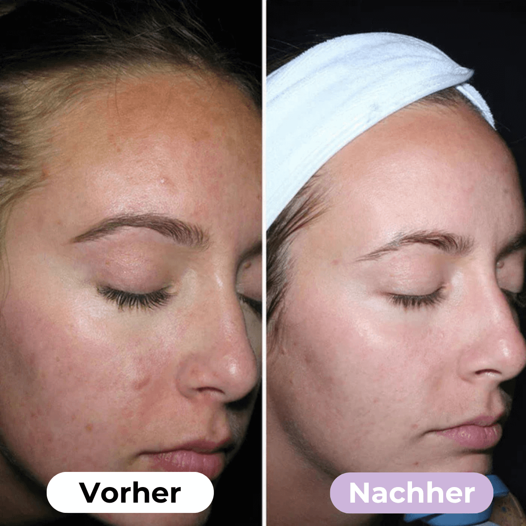 SmoothSkin™ Silicone rimpelpleisters