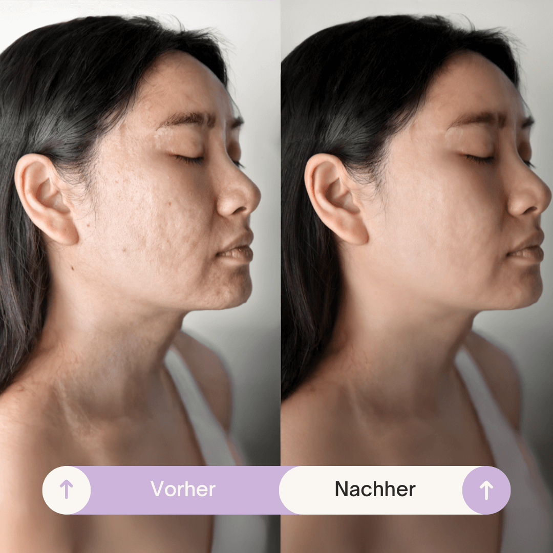 SmoothSkin™ Silicone rimpelpleisters