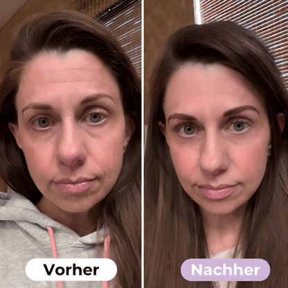SmoothSkin™ Silicone rimpelpleisters