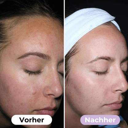 SmoothSkin™ Silicone rimpelpleisters