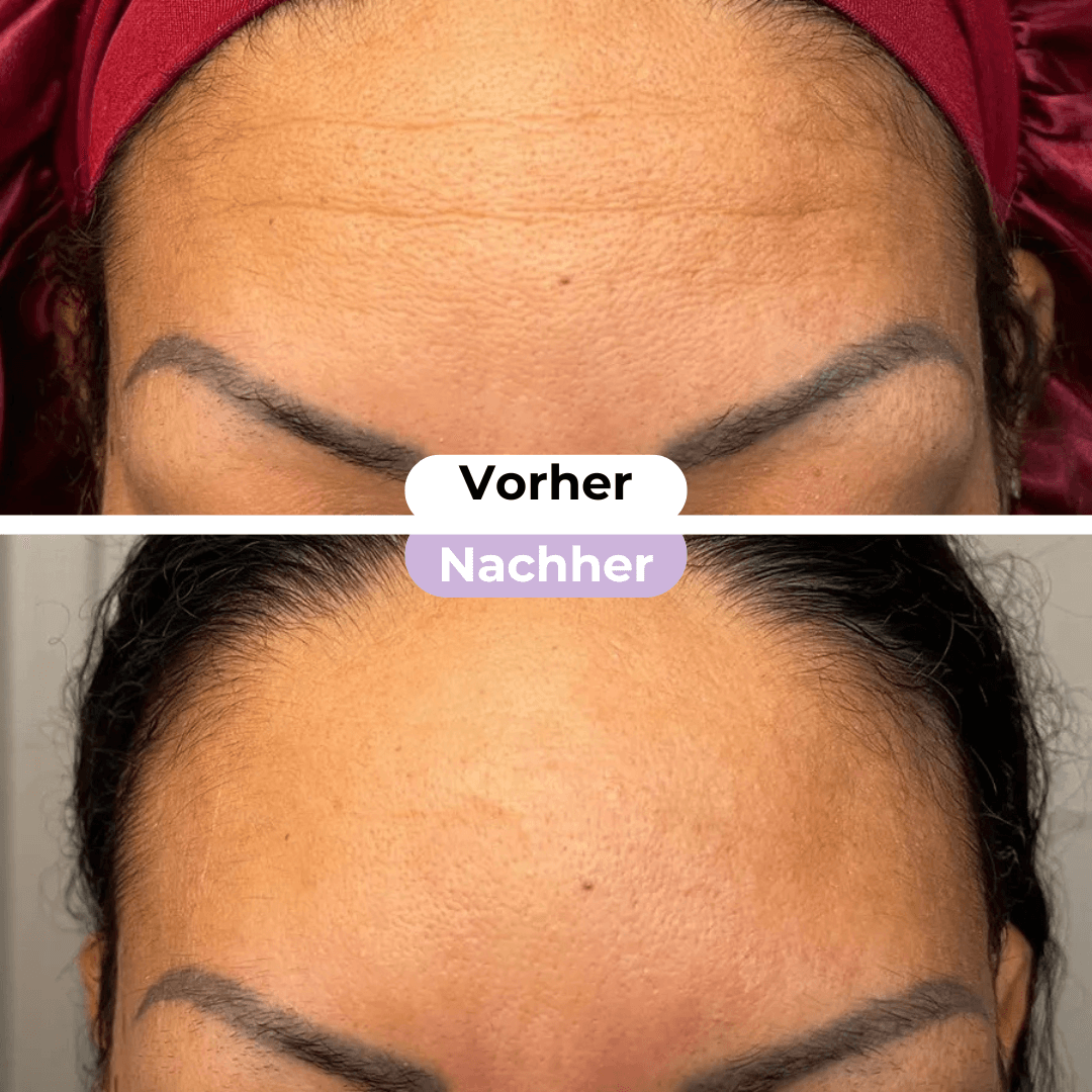 SmoothSkin™ Silicone rimpelpleisters