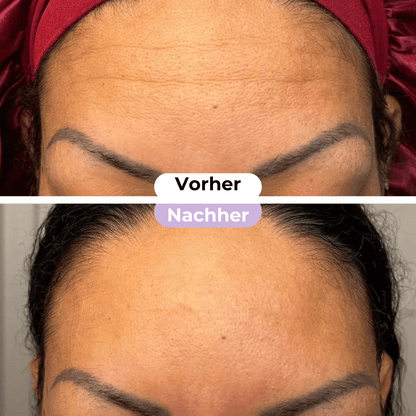 SmoothSkin™ Silicone rimpelpleisters