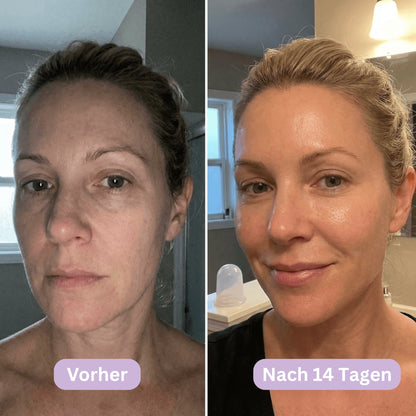 LymphCup™ | Lymphaktivierendes Gesichts-Kontur-System