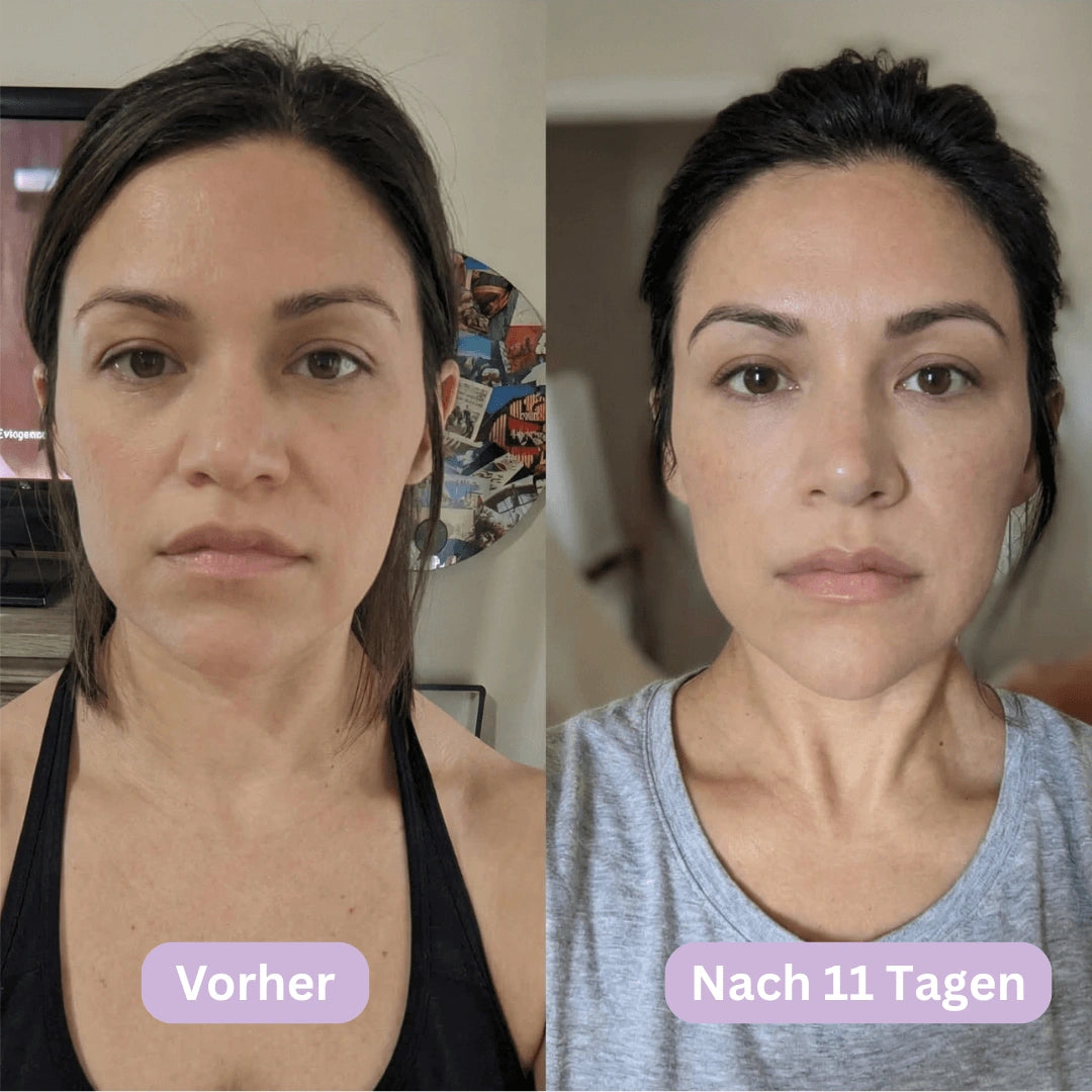 LymphCup™ | Lymphaktivierendes Gesichts-Kontur-System