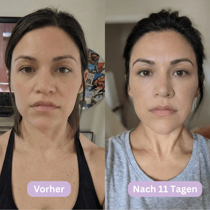 LymphCup™ | Lymphaktivierendes Gesichts-Kontur-System